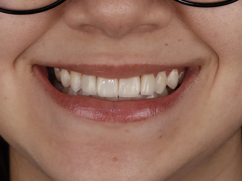 Sorriso frontal com facetas de porcelana nos dentes superiores, caso finalizado na clínica