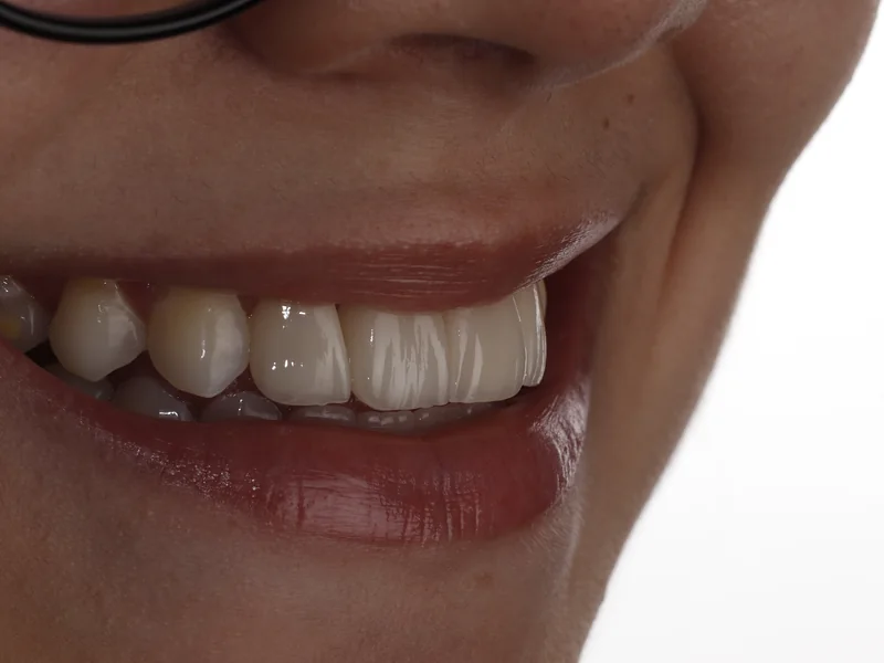 O mesmo sorriso visto de lado, mostrando a translucidez da borda das facetas de porcelana