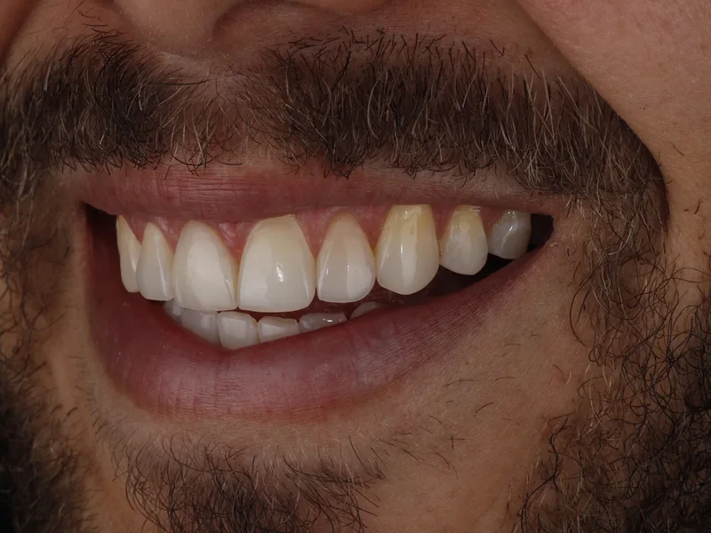Sorriso com facetas de resina composta nos dentes superiores da frente, caso finalizado na clínica